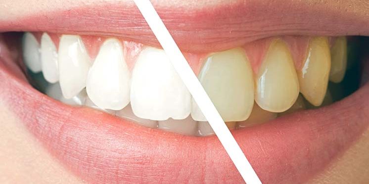 Zahn-Bleaching Holzwickede